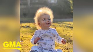 Oneyearold boy has extremely rare ‘uncombable hair syndrome’ l GMA [upl. by Siffre506]