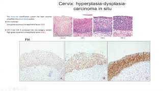 Pathology Made Easy 5 Neoplasia 1 General Features of Neoplasia [upl. by Aivuy146]