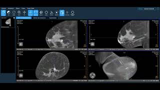 Koning Health Clinical Review Ductal Carcinoma in Situ Calcifications [upl. by Melisent]