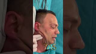 Scarless Facelift By Dr Suleyman Tas for men [upl. by Ehcram]