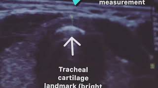 Thyroid ultrasound probe placement and measurements [upl. by Liebermann500]