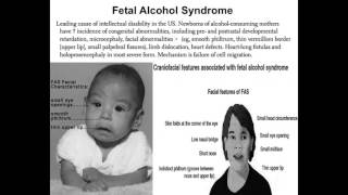 Fetal Alcohol Syndrome USMLE Highly Tested Topic [upl. by Margie119]