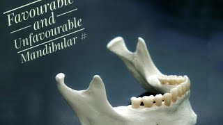 Mandibular Fractures  Favourable and Unfavourable [upl. by Zetnahs]