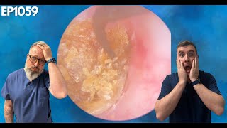 REMOVING THE MOST IMPACTED EAR WAX EVER  EP1059 [upl. by Ibib]