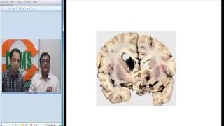 CRANIOPHARYNGIOMA  Radiology and Pathology Correlation [upl. by Eimarrej]