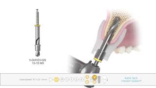 Guided surgery Astra Tech Implant SystemR EV [upl. by Durrej]