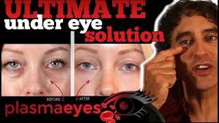 THE ULTIMATE UNDER EYE TREATMENT  PlasmaEyes [upl. by Everard]