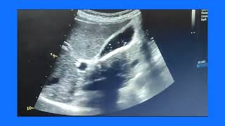 Empyema gallbladder or pyocele or suppurative cholecystitis ultrasound and color Doppler video [upl. by Suneya130]