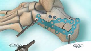 Wright  Ortholoc Calcaneal Fracture system [upl. by Gnous19]