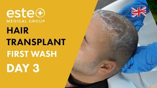 After Hair Transplant  How To Do The First Wash 3rd Day [upl. by Pius]