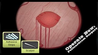 Operate Now Pericardium Surgery Walkthrough [upl. by Kyne]