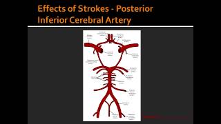 Effects of Strokes  Posterior Inferior Cerebral Artery [upl. by Itsym968]