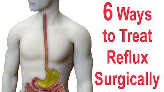 6 Ways to Surgically Treat Reflux Nissen Toupet Dor LINX EsophyX Stretta [upl. by Dorine]