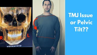 The Truth about Lateral Pelvic Tilt [upl. by Nyliac]