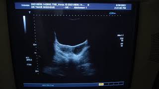 LT HEMATOSALPIX vs PYOSALPINX [upl. by Rubina]