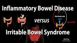 Inflammatory Bowel Disease vs Irritable Bowel Syndrome Animation [upl. by Harutak]