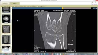 CT Scan  4 Months After PRC [upl. by Eceined]