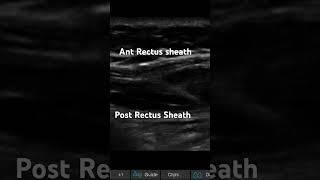 RECTUS SHEATH BLOCK IN LONG AXIS [upl. by Dumond]