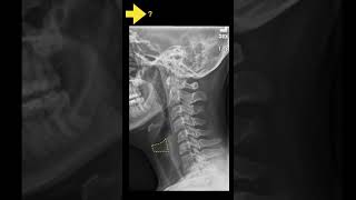 Testing cervical anatomy Xrays Part B shorts [upl. by Assiram]