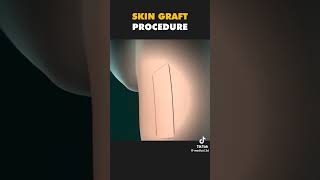 Skin graft procedure biology humanbody medical physiology bodysystem science [upl. by Drawdesemaj]