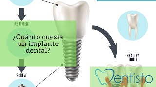 ¿Cuánto cuesta un implante dental [upl. by Amii]