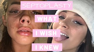 How To Survive A Septoplasty  What I Wish I Knew [upl. by Euqinay]