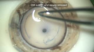 Descemet Membrane Endothelial KeratoplastyDMEK Preparation of Donor cornea [upl. by Ecam]