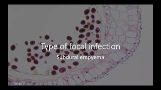 Focal Brain Lesions on CT [upl. by Dalia894]