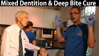 Orthotropics Case Assessment for Deep Bite Correction During Mixed Dentition Period by Dr Mike Mew [upl. by Einal]