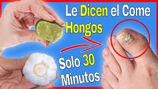 Con Usarlo 1 Vez al día Podrás Quitar los Hongos de las Uñas de los Pies Rápidamente [upl. by Elatia451]