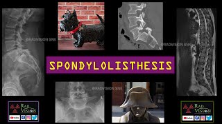 SPONDYLOLISTHESIS [upl. by Eduard]