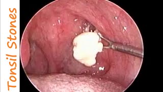 Huge Tonsil Stones Removal in a case of Chronic Tonsillitis amp Allergic Rhino Sinusitis [upl. by Toddy]