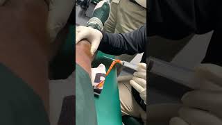 Extracting knee fluid JoshButlerTv [upl. by Andy]