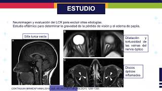 Actualización en Hipertensión Intracraneal Idiopática [upl. by Anaiv]