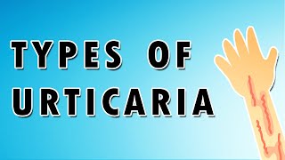 Urticaria Symptoms Treatment and Causes [upl. by Horbal]