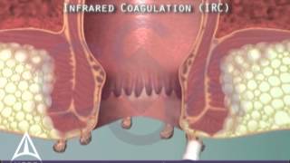 Anal warts amp infrared coagulation treatment  3D animation [upl. by Nreval]