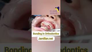 Steps of Bonding in Orthodontics [upl. by Haveman]