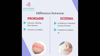 Difference between Eczema and Psoriasis [upl. by Oer242]