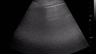 CASE 879 LUNG ULTRASOUND BILATERAL MASSIVE PULMONARY FIBROSIS DD pulmonary edema [upl. by Dulla]