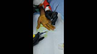 Warts Removal  Ketuat by Dr Fadhilah  Klinik Fadhilah Bukit Katil Melaka [upl. by Ylelhsa899]