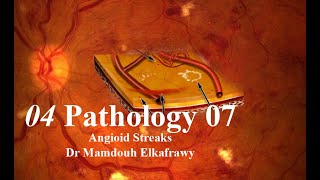 04 Retinal Pathology 07 Elkafrawy pathology باثولوجيالكفراوي Angioid Streaks [upl. by Annaes]