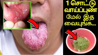 இத வச்சா வாய்ப்புண் 3 நிமிடத்தில் ஆறிவிடும்  vai punn aara  vai pun aara marunthu in tamil [upl. by Bridget809]