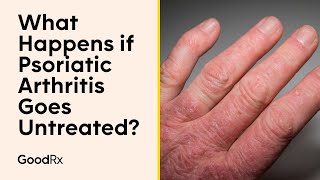 What Happens if Psoriatic Arthritis Goes Untreated  GoodRx [upl. by Ellednahs]