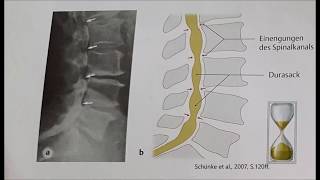 Bandscheibenvorfall und Wirbelsäulenerkrankungen [upl. by Burk]