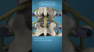 What is Posterior Lumbar Interbody Fusion  PLIF Shorts [upl. by Romeu]