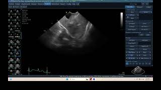 IQ 298 TFAST LUNG MEDIASTINAL LYMPHOID NODE ENLARGEMENT HWD ECHOPAC ANALYSIS [upl. by Blanchette65]