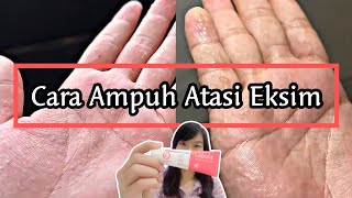 AKHIRNYA NEMU SKINCARE YANG AMPUH ATASI EKSIMKU‼️  EKSIM DISHIDROSIS  POMPHOLYX [upl. by Adoree]