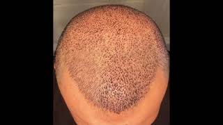 DHI Hair Transplant  6 weeks result  4300 graft  Dr Serkan Aygın Clinic [upl. by Rubetta]