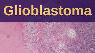 What is a Glioblastoma  Pathology mini tutorial [upl. by Freda]