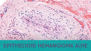 Epithelioid hemangiomaangiolymphoid hyperplasia w eosinophilia Australasian Dermpath 2022 Case 8 [upl. by Myrna]